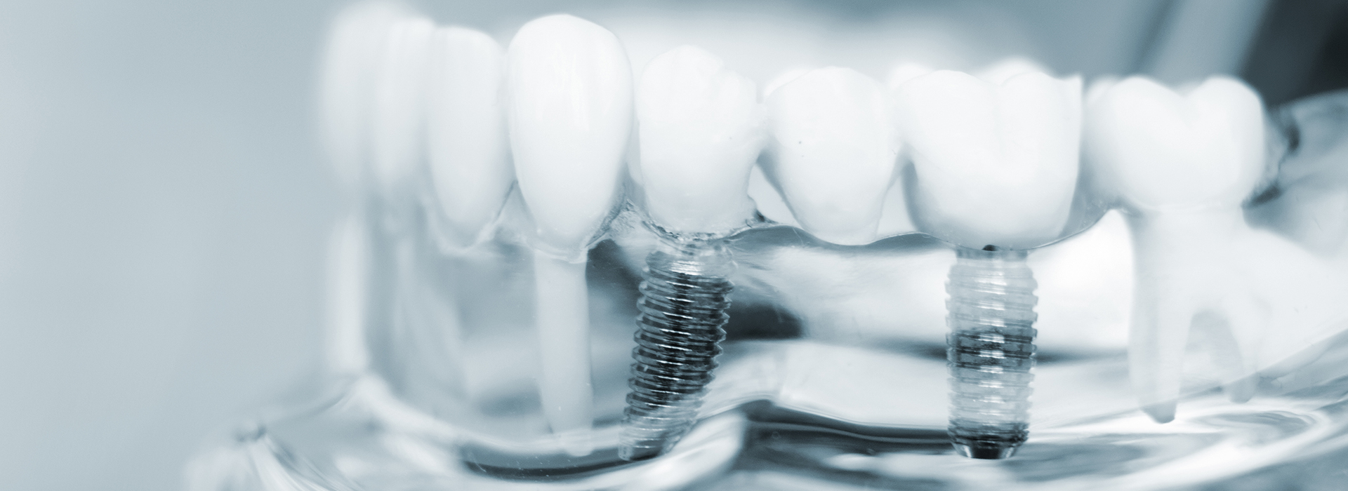 Village Dental | Dental Bridges, Veneers and Implant Dentistry